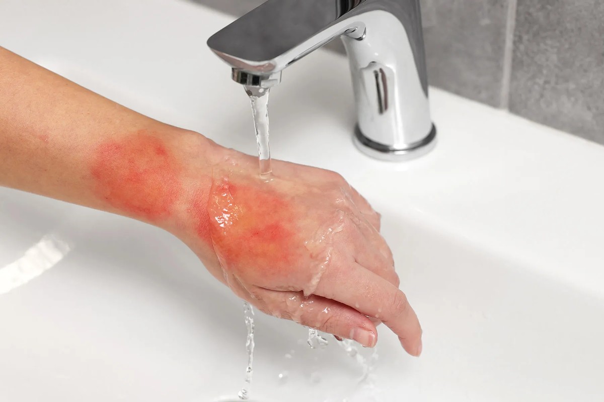 Sanitäter berichten: Warum du niemals warmes Wasser für die Reinigung nutzen solltest - image 1