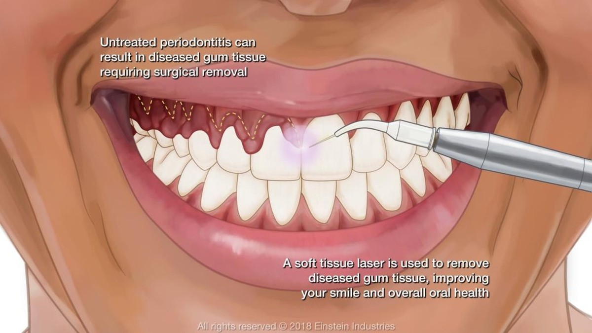 Kaugummi unter dem Tisch? Mit Eis entfernt man es in 30 Sekunden